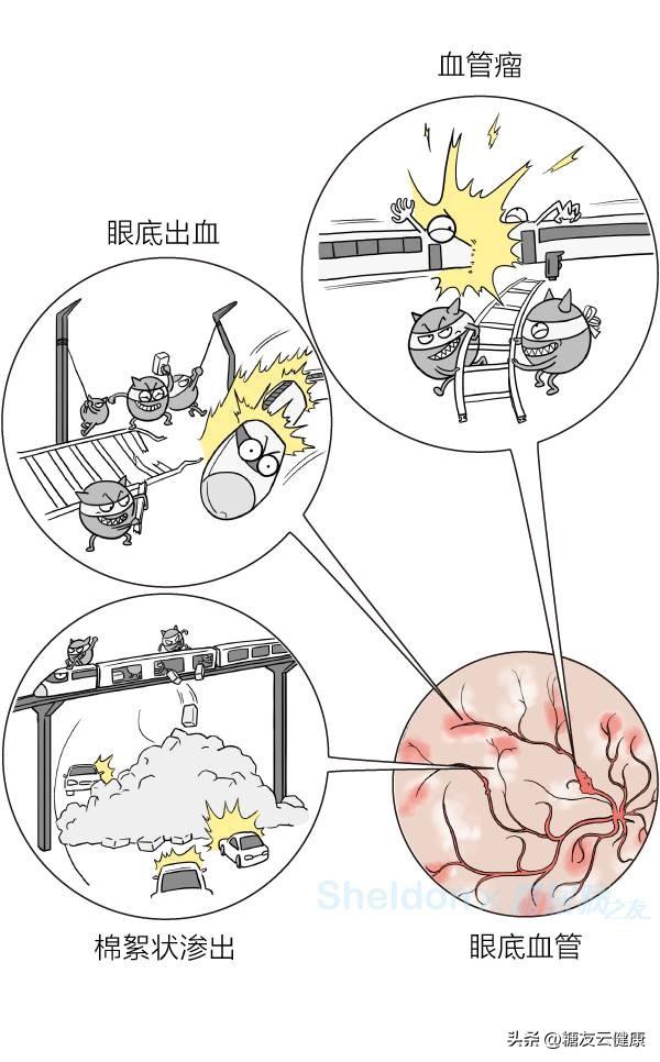 动眼神经三个月后恢复的奇迹