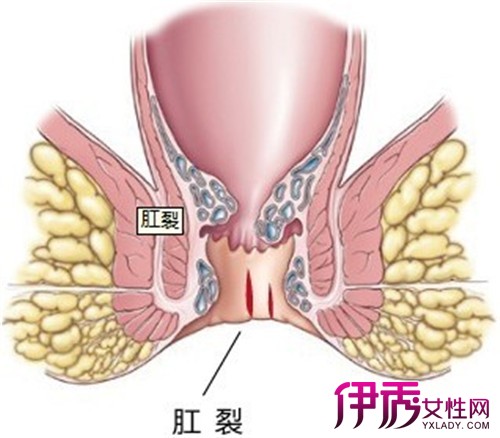 三个月宝宝肛裂怎么办？全面解析应对之策