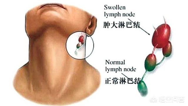 淋巴结两个月无变化，观察与解读